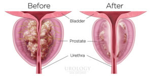 best natural prostate supplements